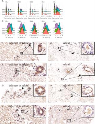 Activation of the NFκB signaling pathway in IL6+CSF3+ vascular endothelial cells promotes the formation of keloids